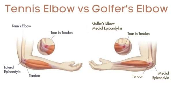 tennis elbow vs golf elbow